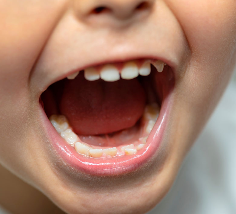 a-little-boy-with-an-open-mouth-showing-milk-teeth-2023-11-27-05-12-39-utc